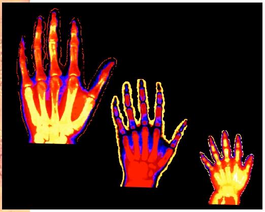 Computer color-enhanced X ray depicting the hand development of a two, six, and nineteen year old male.